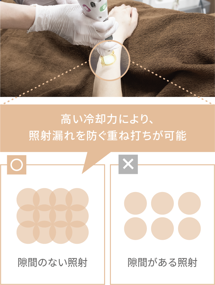 重ね打ち照射（オーバーラップ）