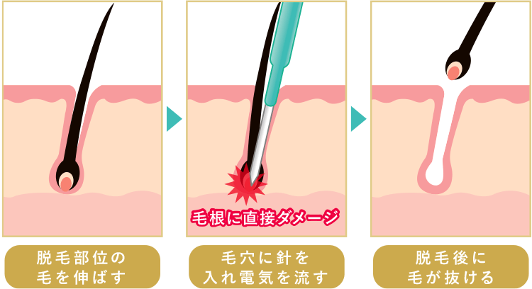脱毛部位の毛を伸ばす、毛穴に針を入れ電気を流す、脱毛後に毛が抜ける