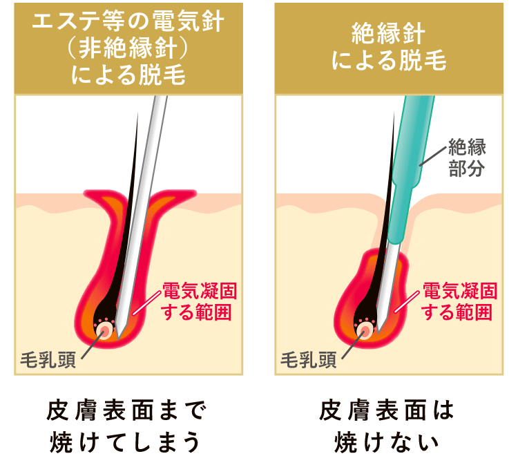 ニードル脱毛(医療針脱毛)｜船橋の医療脱毛専門クリニック｜クレスト 