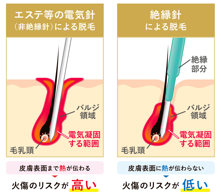 ニードル脱毛(医療針脱毛・絶縁針脱毛)｜医療脱毛専門のクレストスキン