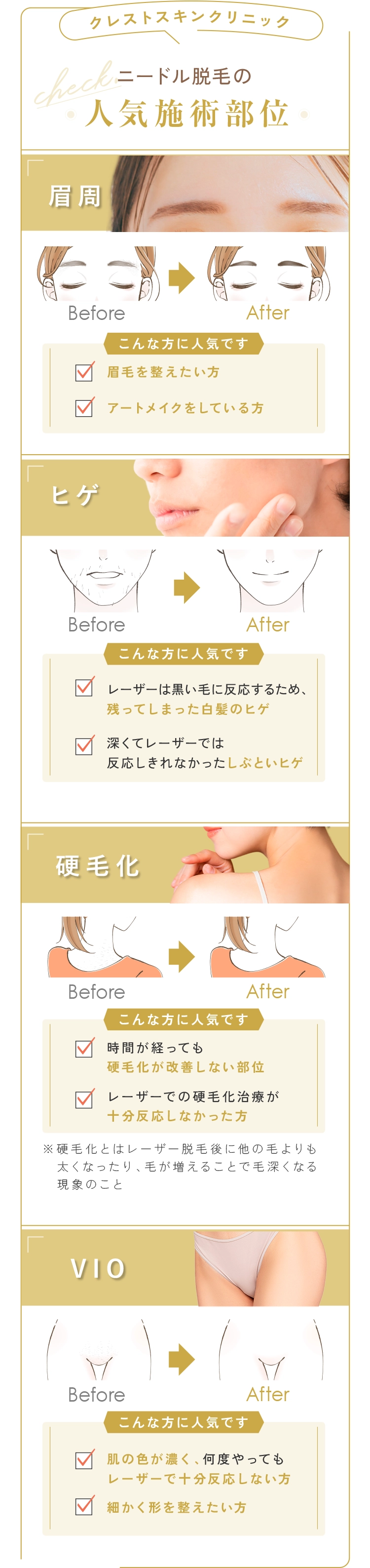 ニードル脱毛の人気施術部位