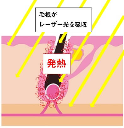 レーザー光を毛根に吸収させ発熱