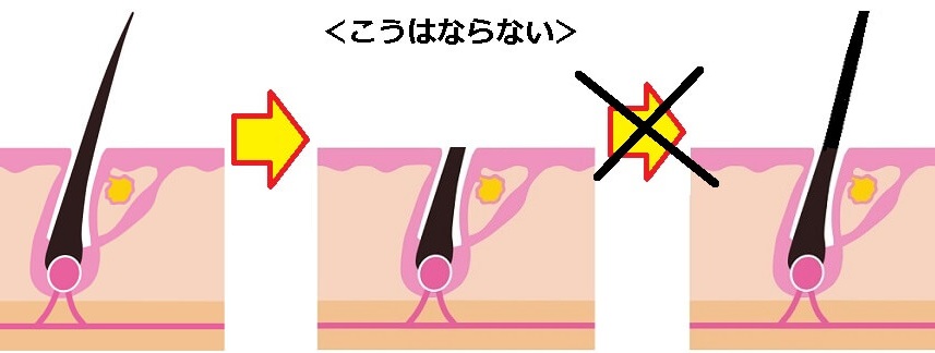 剃った毛が元の長さに戻る