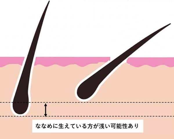 直立の毛、ななめの毛
