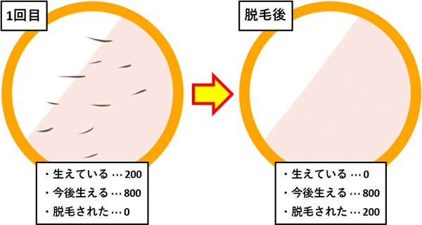 脱毛1回目、毛穴1000