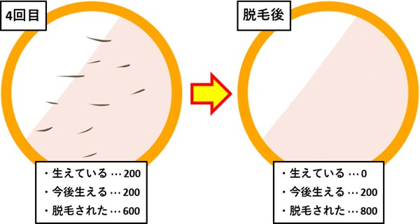脱毛4回目