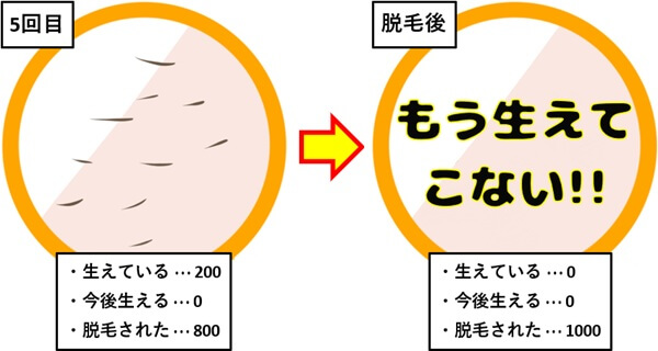 脱毛5回目、完了