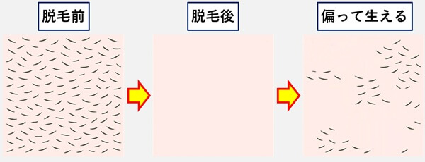 脱毛後偏って生える
